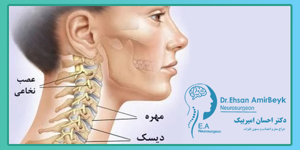 علائم دیسک گردن