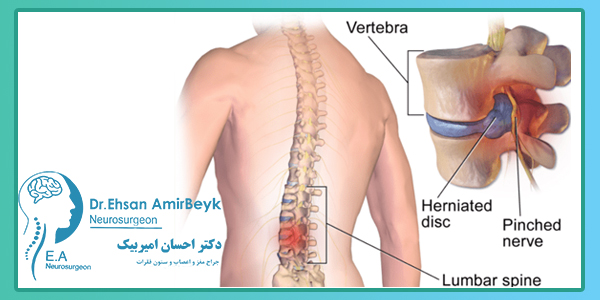 علایم دیسک کمر