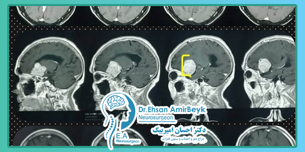 یک نمونه از سیتی اسکن تومور مننژیوم را مشاهده کنید