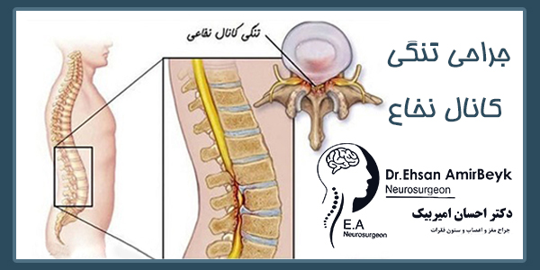 عمل جراحی تنگی کانال نخاع: راهنمای جامع و نمونه عمل
