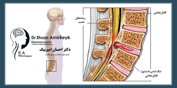 تنگی کانال نخاع