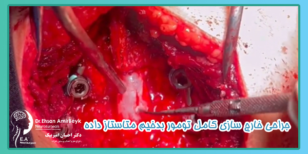 جراحی خارج سازی کامل تومور بدخیم متاستاز داده