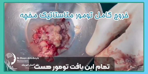 خروج کامل تومور متاستاتیک مخچه