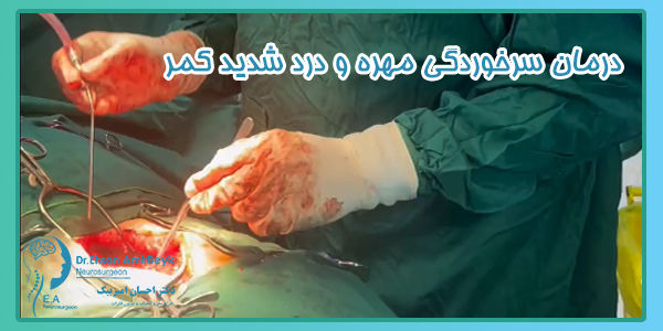 درمان سرخوردگی مهره و درد شدید کمر