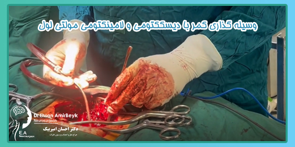 وسیله گذاری کمر با دیسککتومی و لامینکتومی مولتی لول