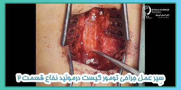 سِیر عمل جراحی تومور کیست درموئید نخاع