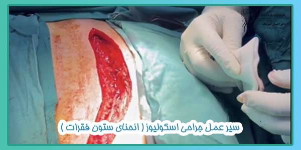 سیر عمل جراحی اسکولیوز ( انحنای ستون فقرات )