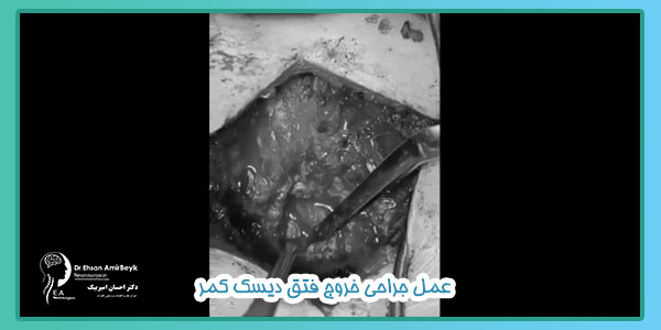 عمل جراحی خروج فتق دیسک کمر