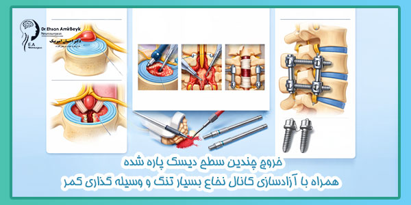خروج چندین سطح دیسک پاره شده همراه با آزادسازی کانال نخاع بسیار تنگ و وسیله گذاری کمر