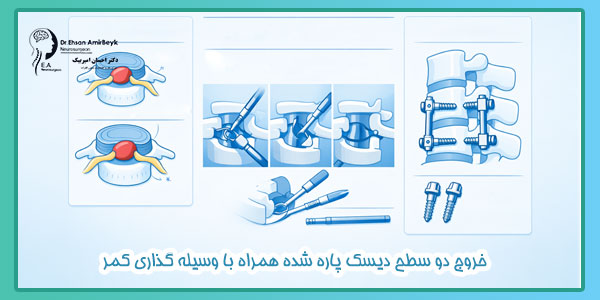 خروج دو سطح دیسک پاره شده همراه با وسیله گذاری کمر