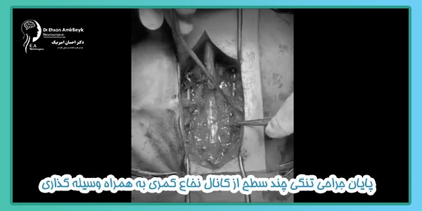 پایان جراحی تنگی چند سطح از کانال نخاع کمری به همراه وسیله گذاری